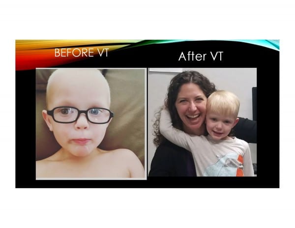 Before vs after vision therapy